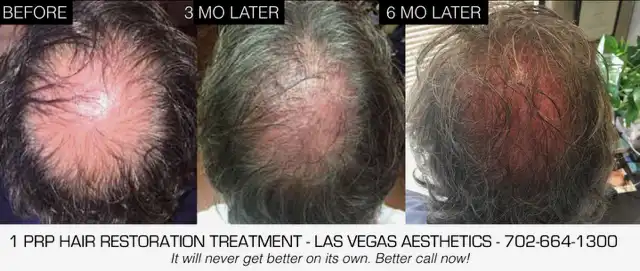 PRP hair restoration before and after, patient 3