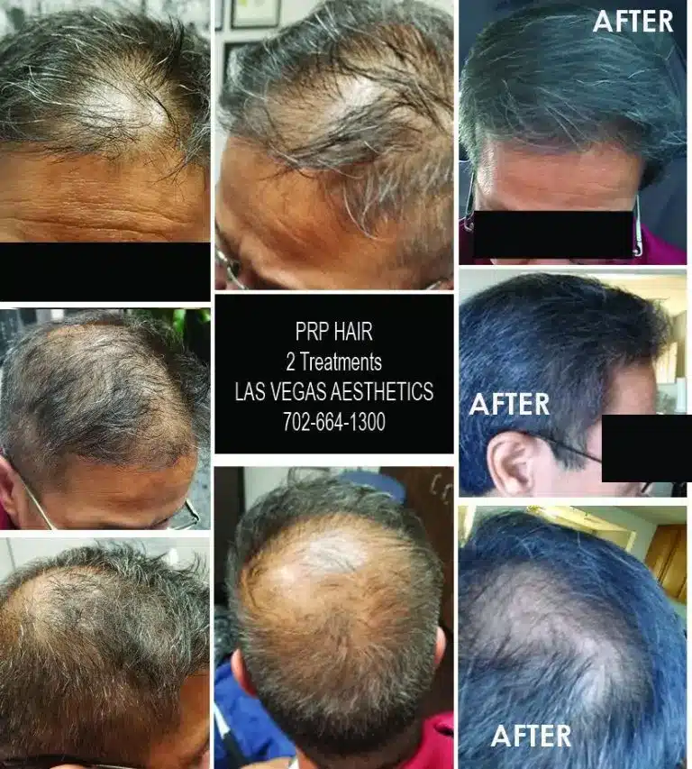 PRP hair restoration before and after, patient 1