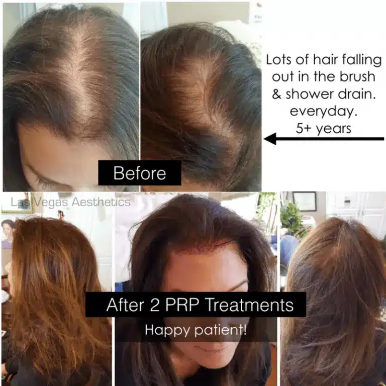 PRP hair restoration before and after, patient 2