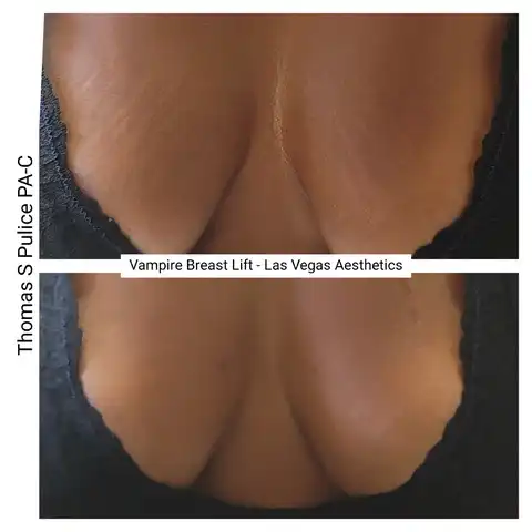 Vampire Breast Lift before and after result 1