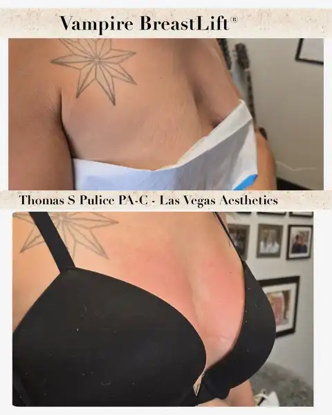 Vampire Breast Lift before and after result 2