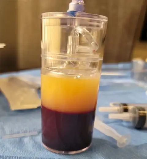 Concentrated platelet-rich plasma prepared for a Vampire Facelift injection