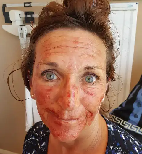 Real Vampire Facelift patient immediately following PRP injection