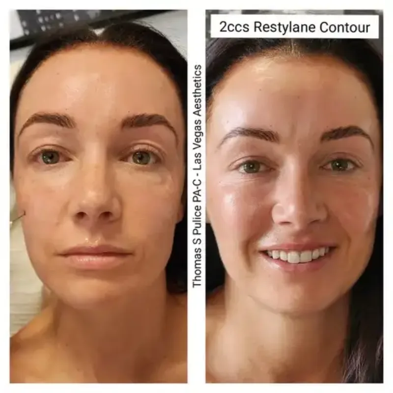 Restylane Contour before and after, cheek volume, Las Vegas Aesthetics