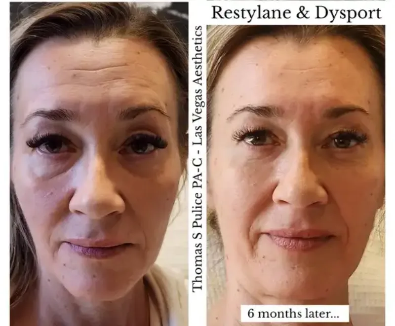 Dysport and Restylane before and after, 6 months, Las Vegas Aesthetics