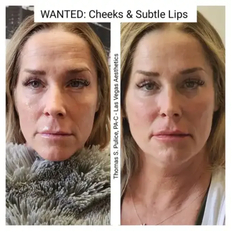Restylane cheek and lip before and after, Las Vegas Aesthetics