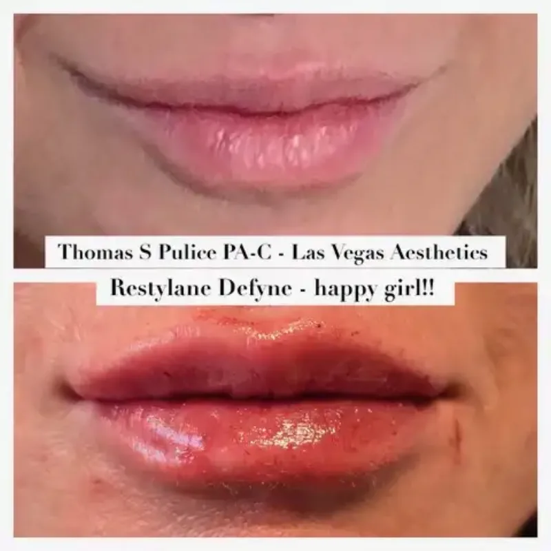 Restylane Defyne before and after, lip enhancement, Las Vegas Aesthetics