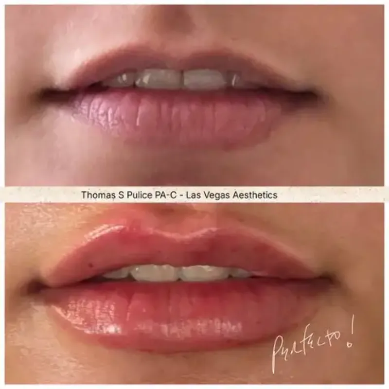 Restylane lip filler before and after, Las Vegas Aesthetics