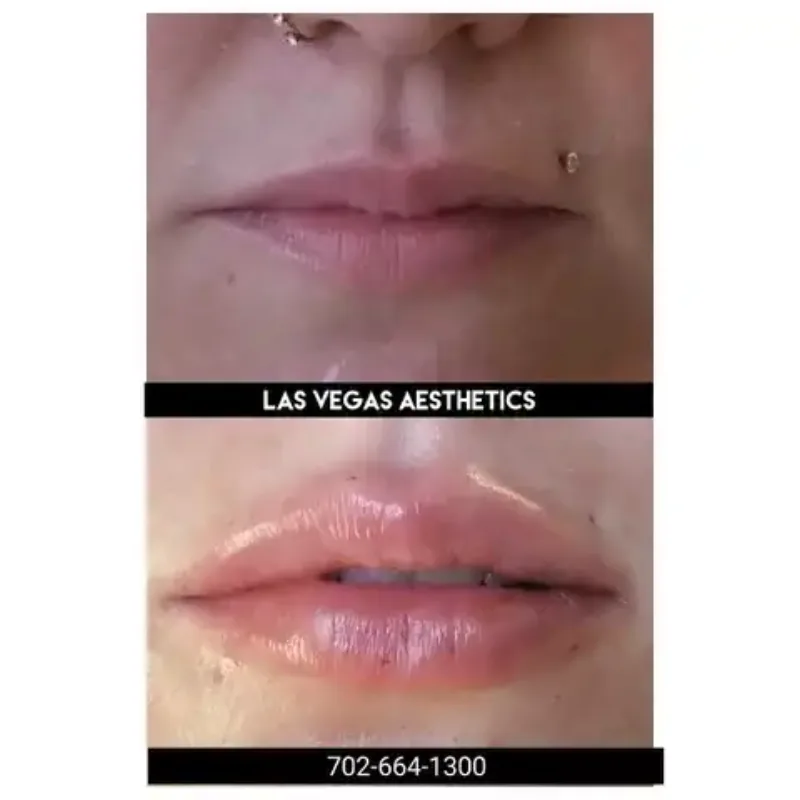 Restylane lip filler before and after, natural fullness, Las Vegas Aesthetics