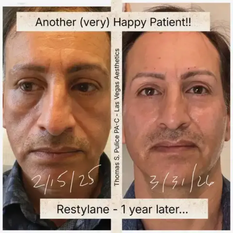 Restylane before and after, male patient, 1 year, Las Vegas Aesthetics