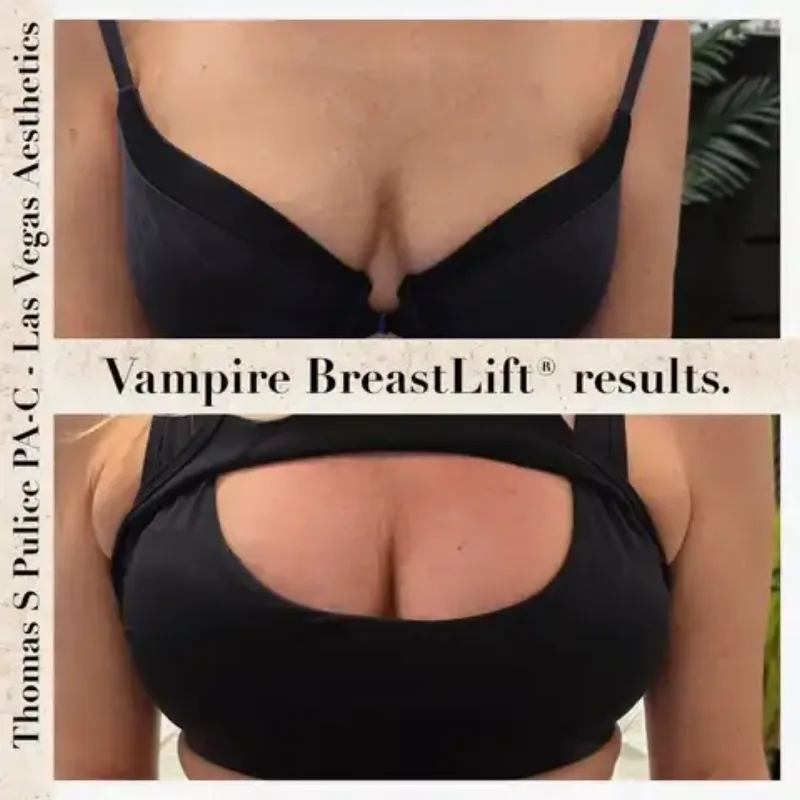 Vampire Breast Lift before and after results, Las Vegas Aesthetics