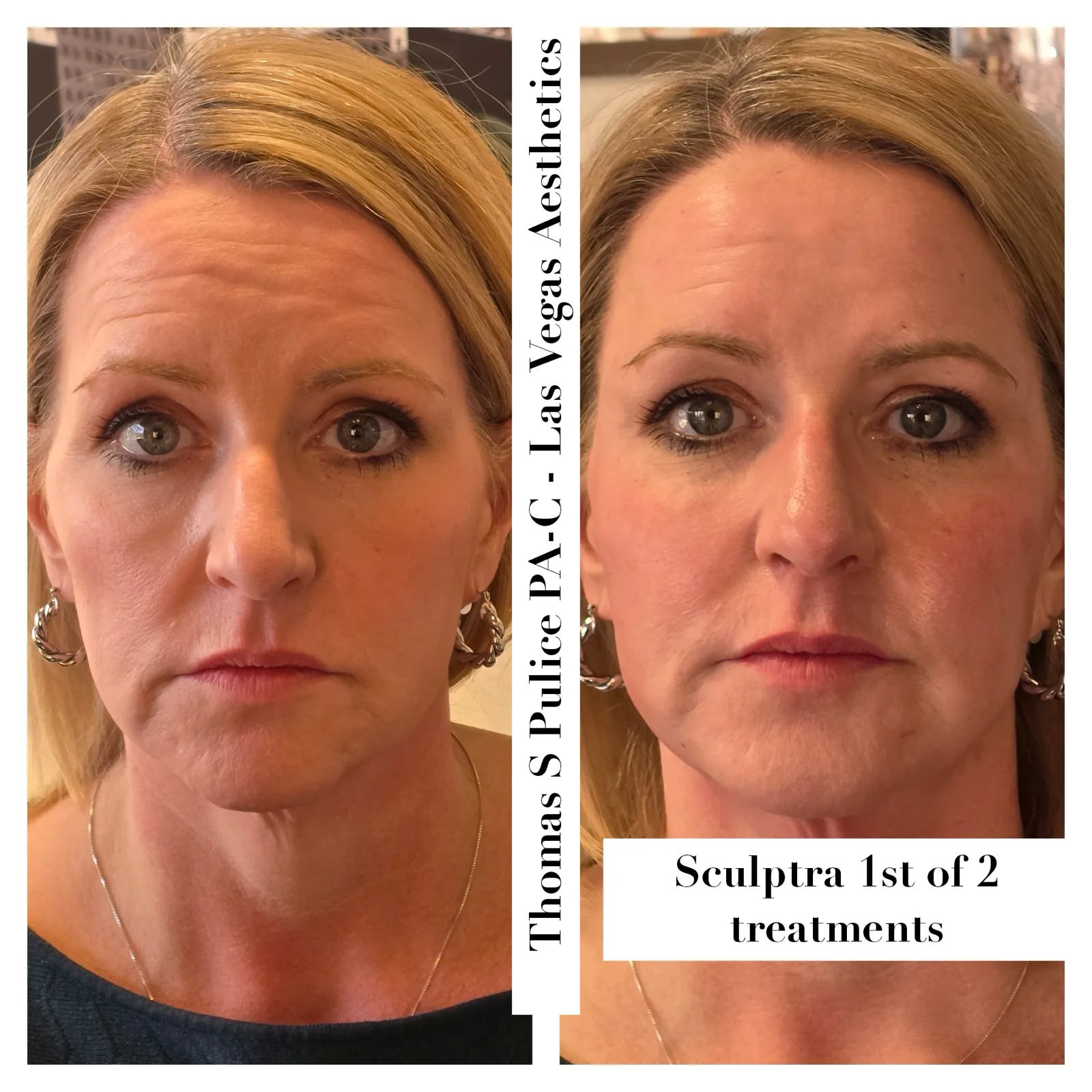Sculptra before and after, 1st of 2 treatments, Las Vegas Aesthetics