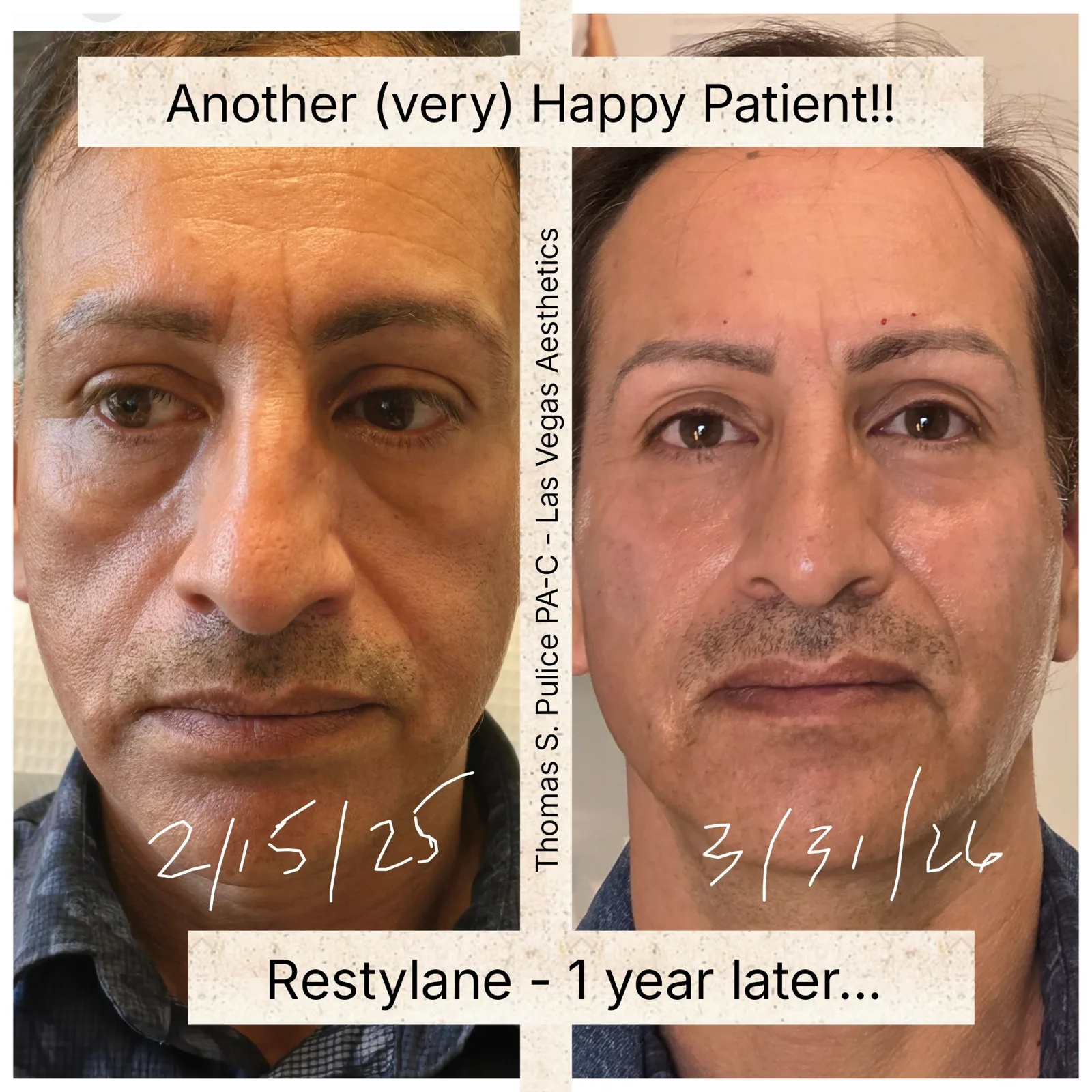 Restylane before and after, male patient, one year later, Las Vegas Aesthetics