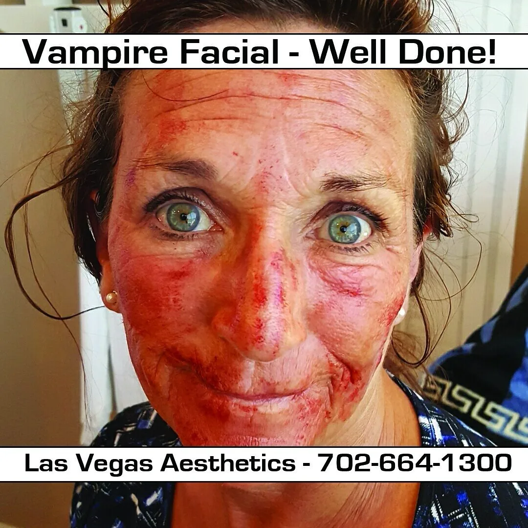 Vampire Facial, fresh off treatment, Las Vegas Aesthetics