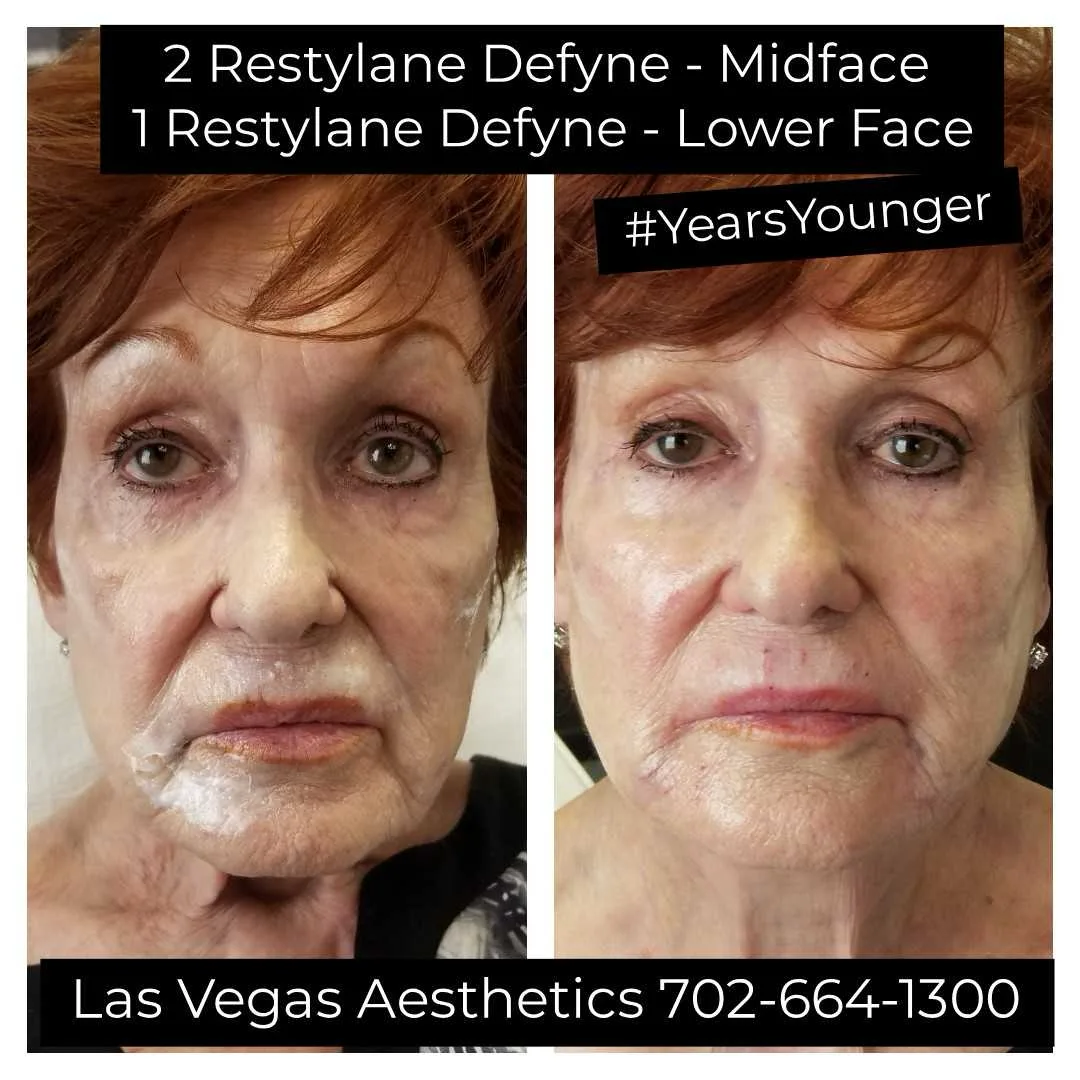 Restylane Defyne before and after, midface and lower face, Las Vegas Aesthetics