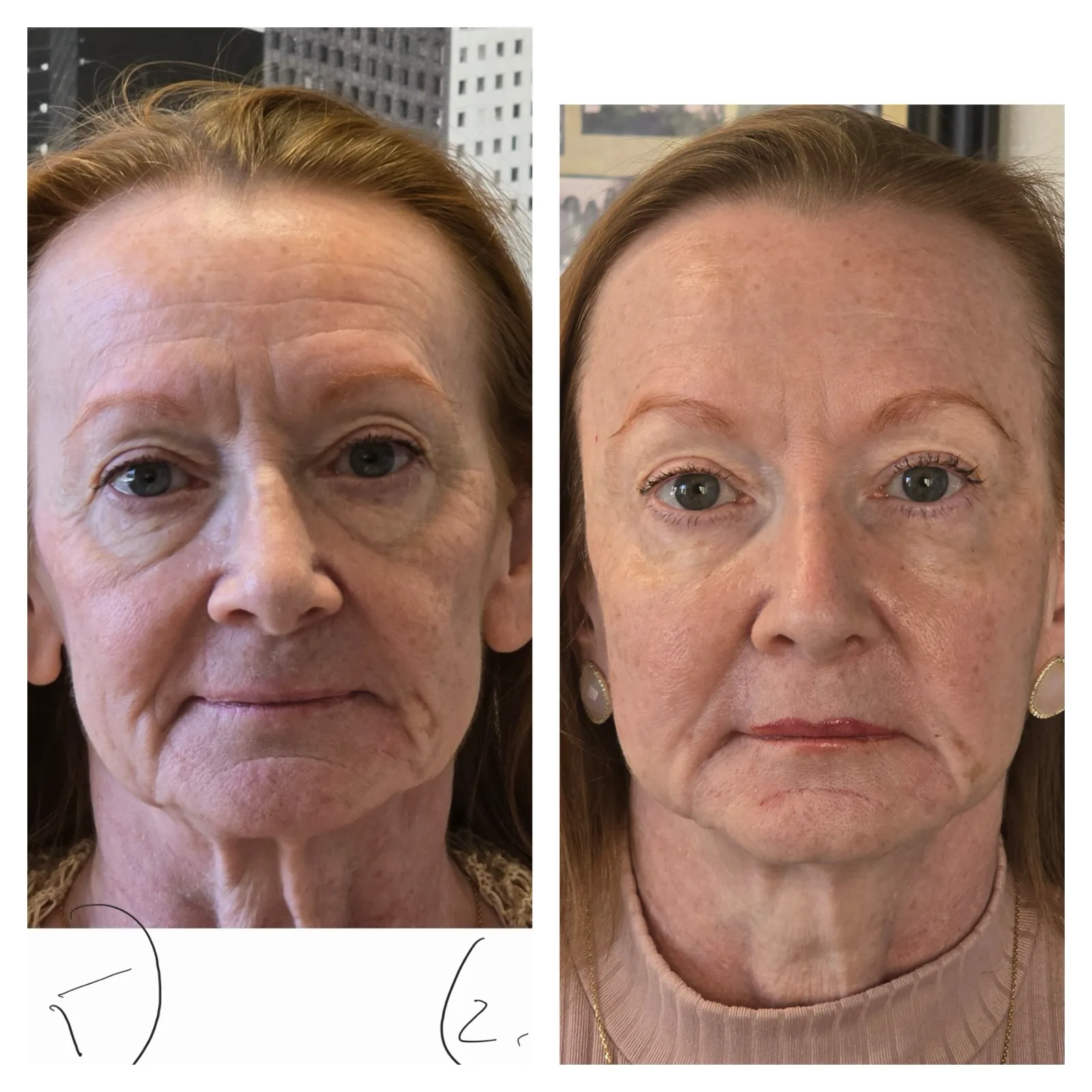 Sculptra before and after, 2 vials, Las Vegas Aesthetics