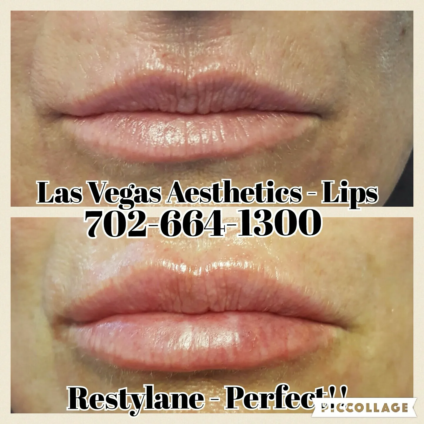 Lip filler before and after, natural enhancement, Las Vegas Aesthetics