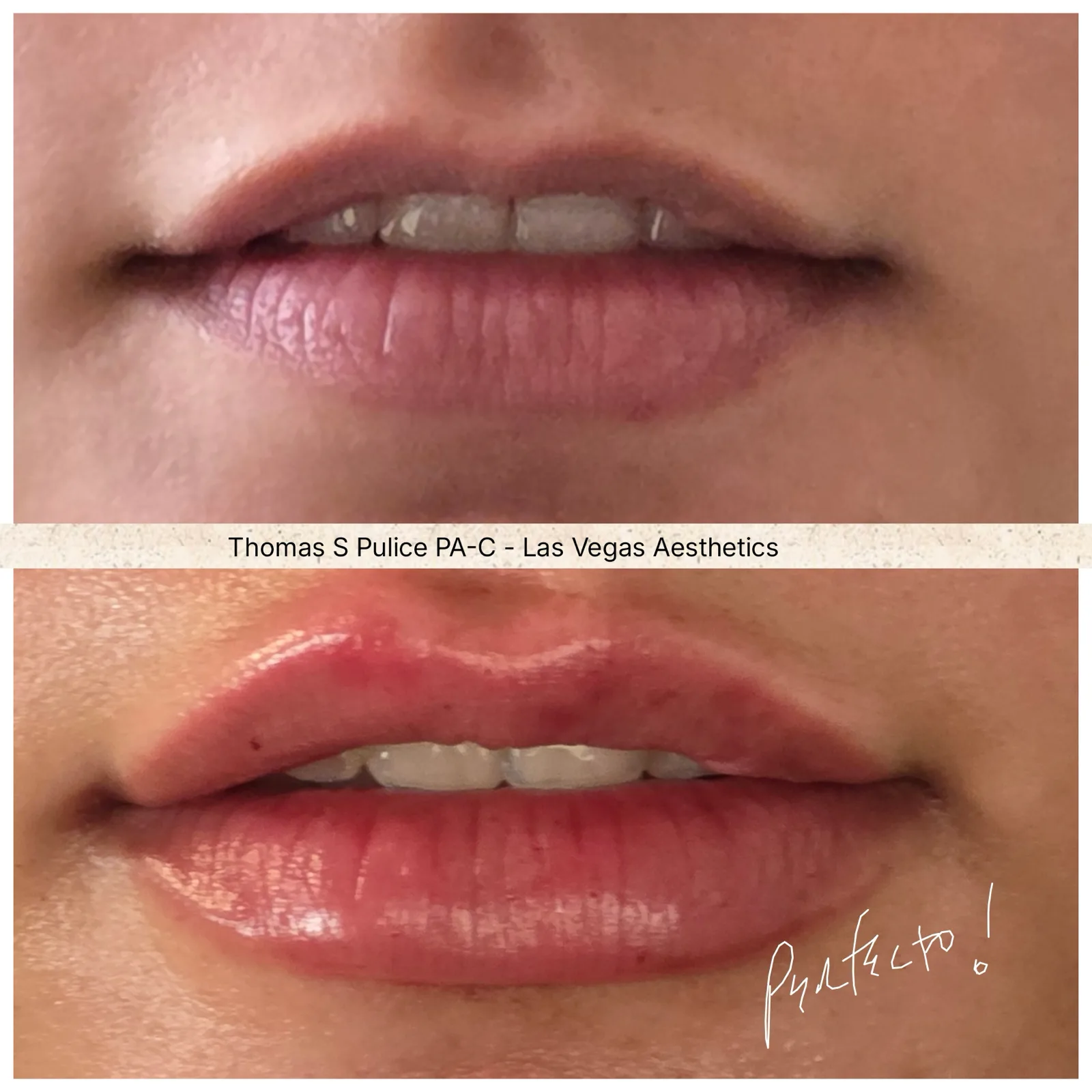 Lip filler before and after, Las Vegas Aesthetics