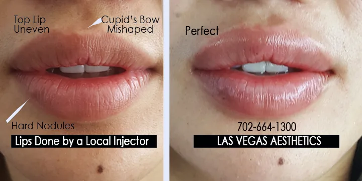 Lip filler before and after, cupid's bow correction, Las Vegas Aesthetics