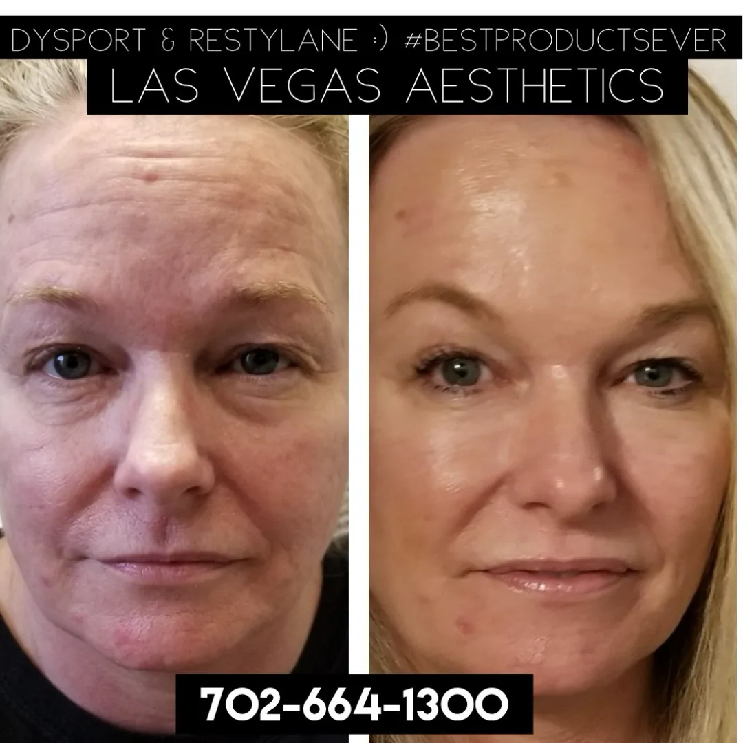 Dysport and Restylane before and after, full face, Las Vegas Aesthetics