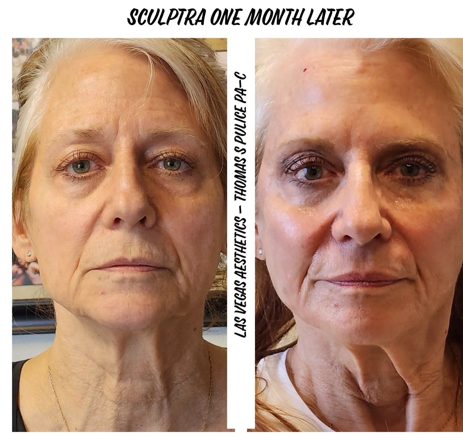 Sculptra before and after, one month later, Las Vegas Aesthetics