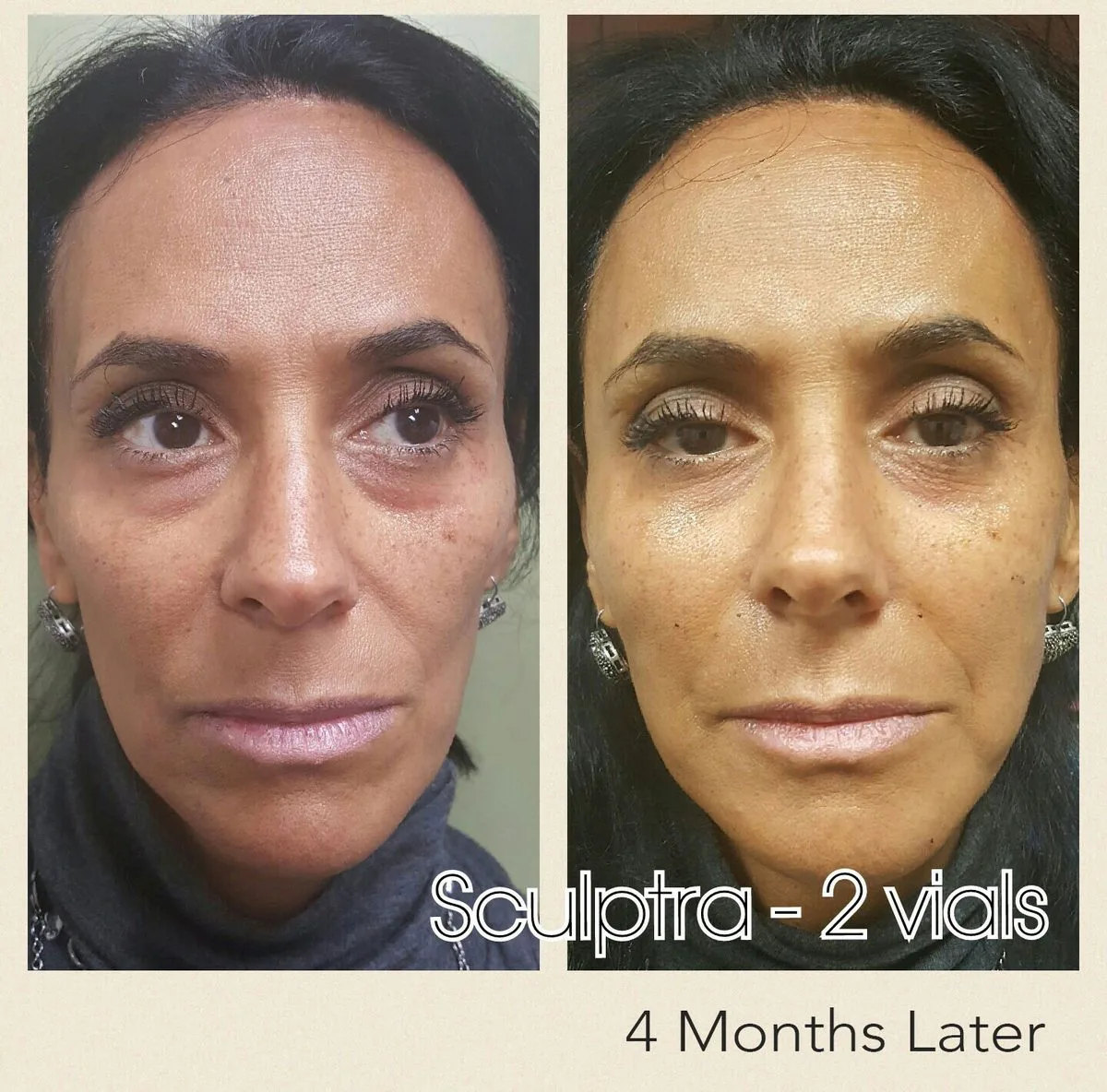 Sculptra before and after, 2 vials, 4 months later, Las Vegas Aesthetics