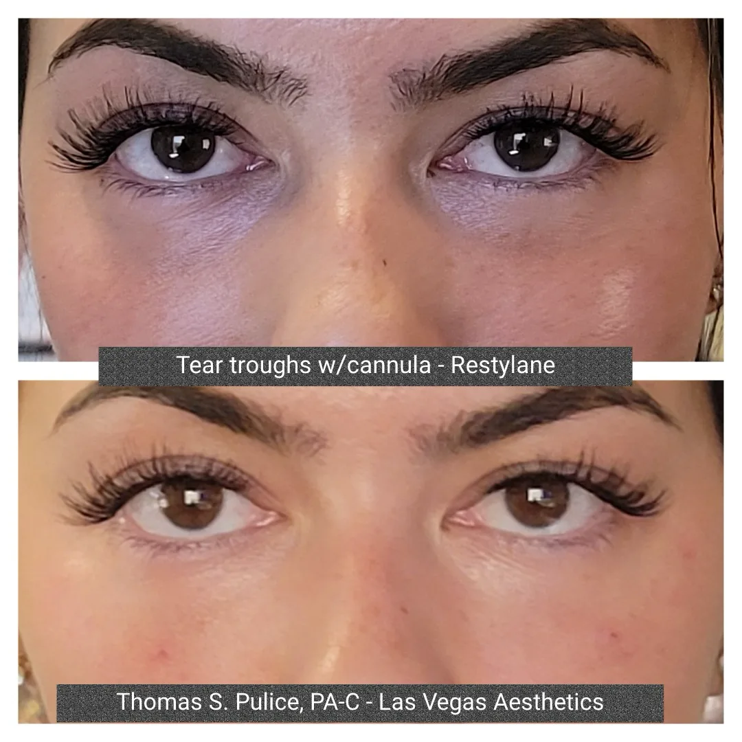 Under-eye filler before and after, tear troughs, Las Vegas Aesthetics