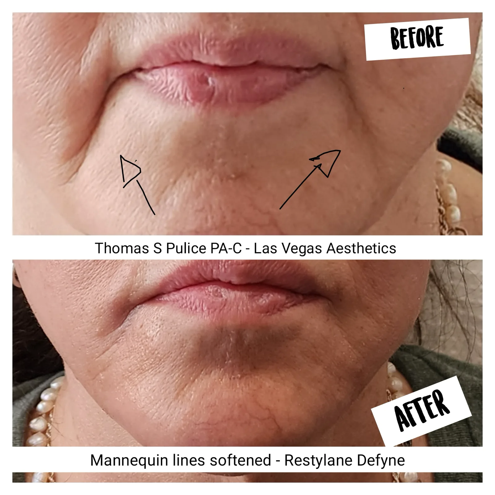 Restylane Defyne before and after, mannequin lines softened, Las Vegas Aesthetics