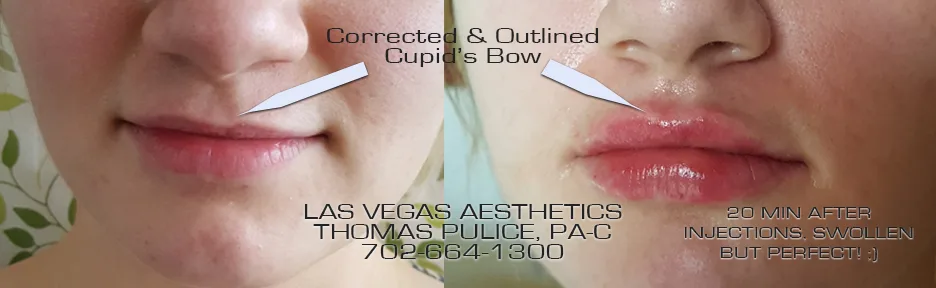 Lip filler before and after, cupid's bow corrected and outlined, Las Vegas Aesthetics
