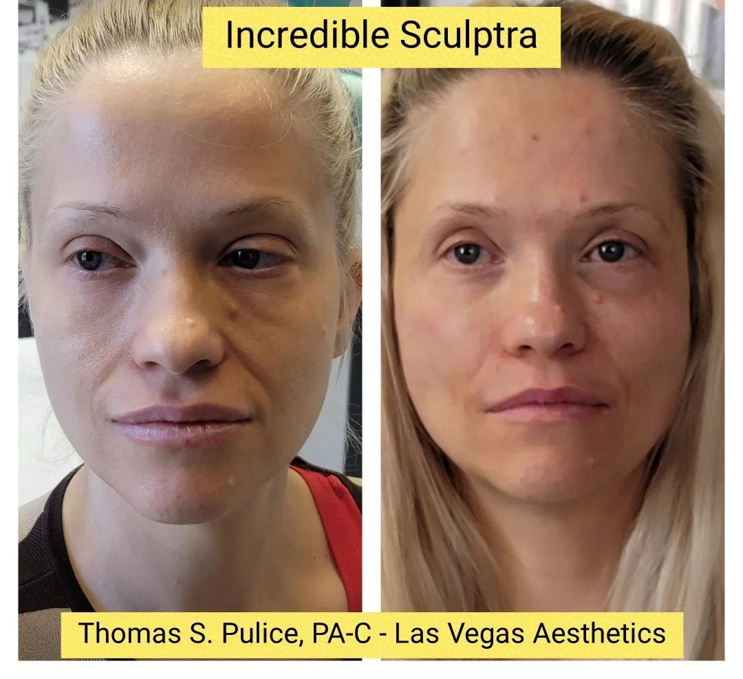 Sculptra before and after, incredible results, Las Vegas Aesthetics