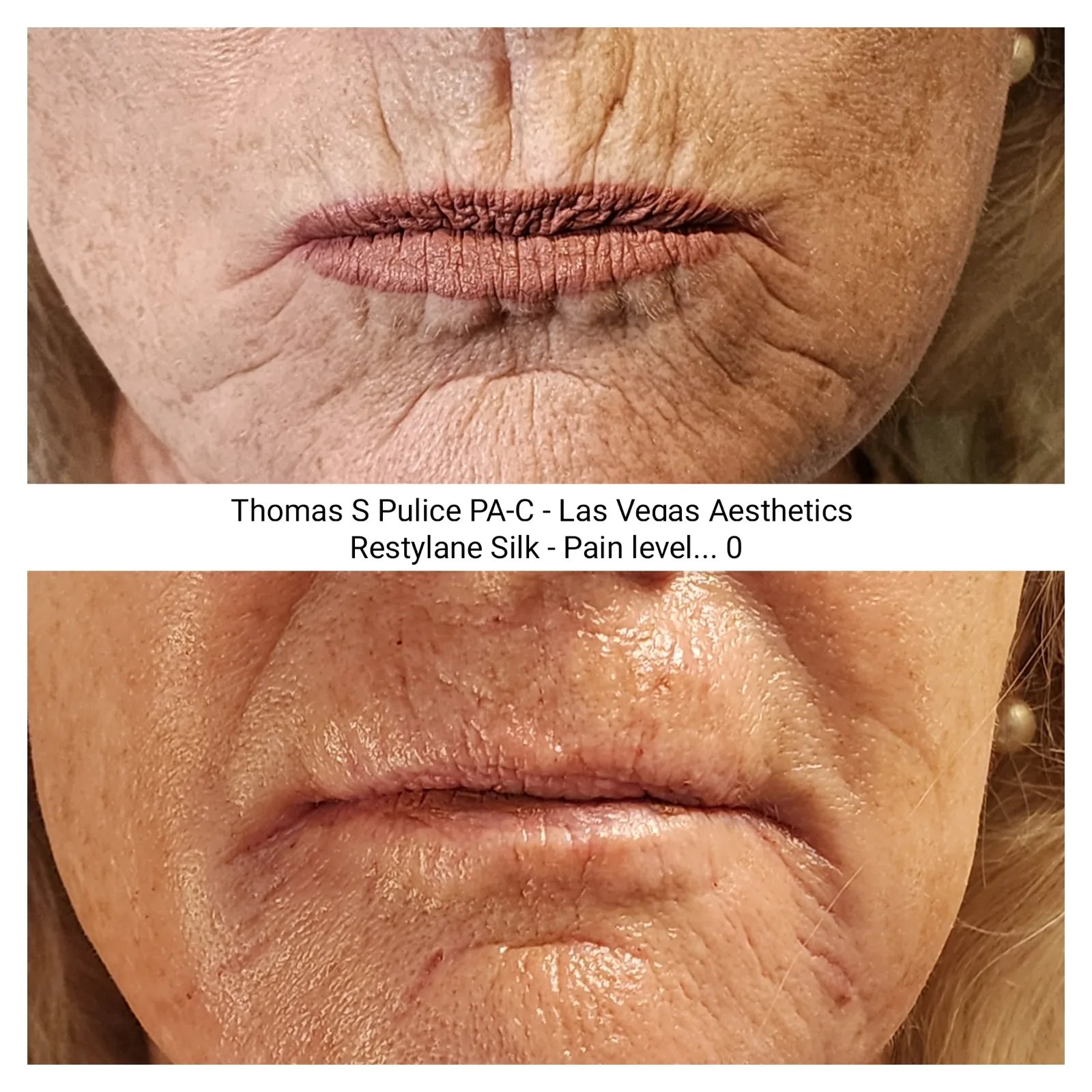 Restylane Silk before and after, lip lines, Las Vegas Aesthetics
