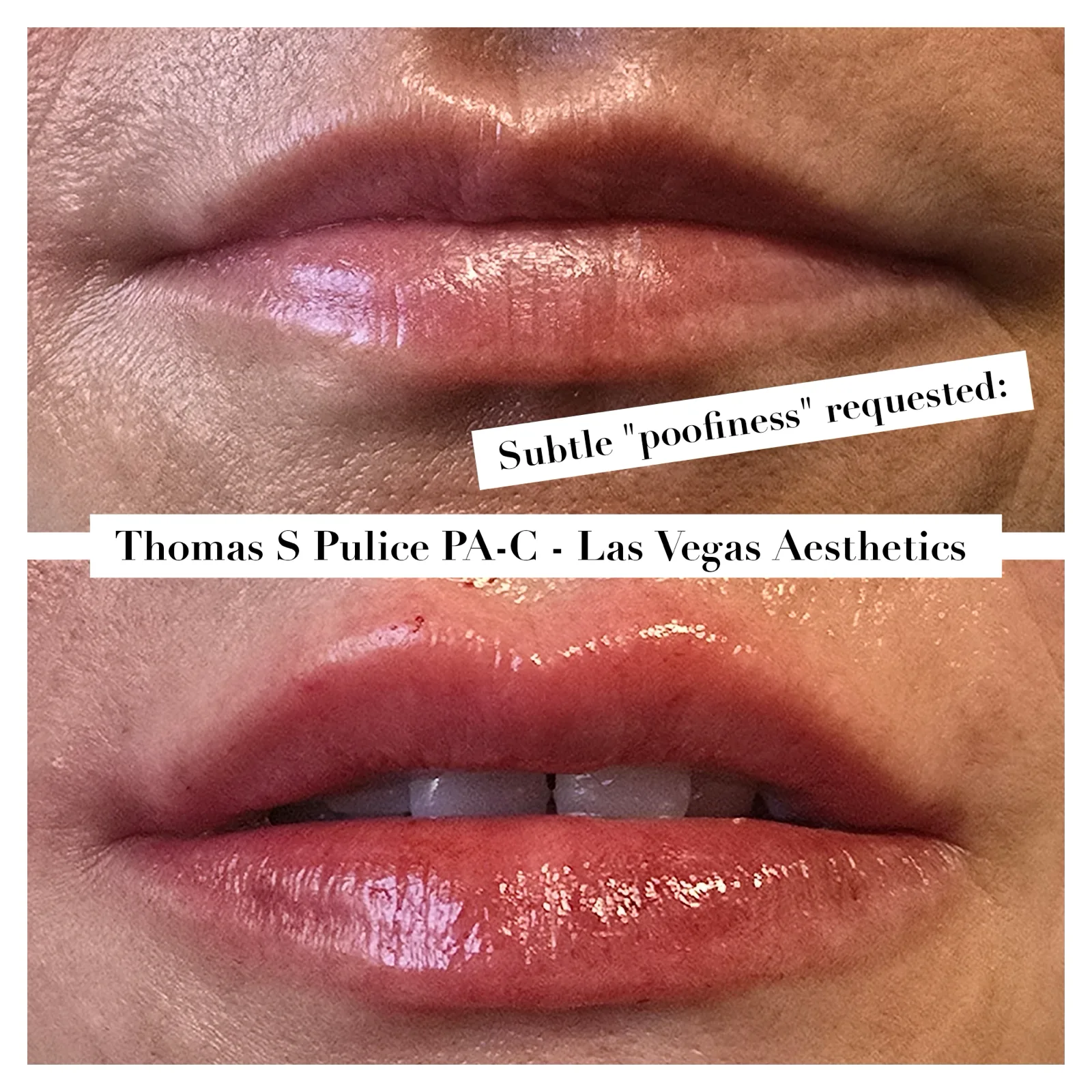 Lip filler before and after, subtle poofiness, Las Vegas Aesthetics