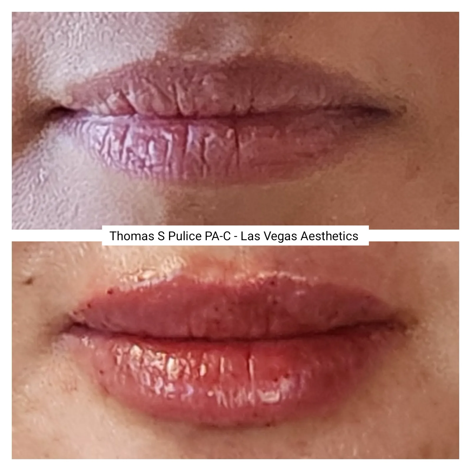 Lip filler before and after, full lip enhancement, Las Vegas Aesthetics