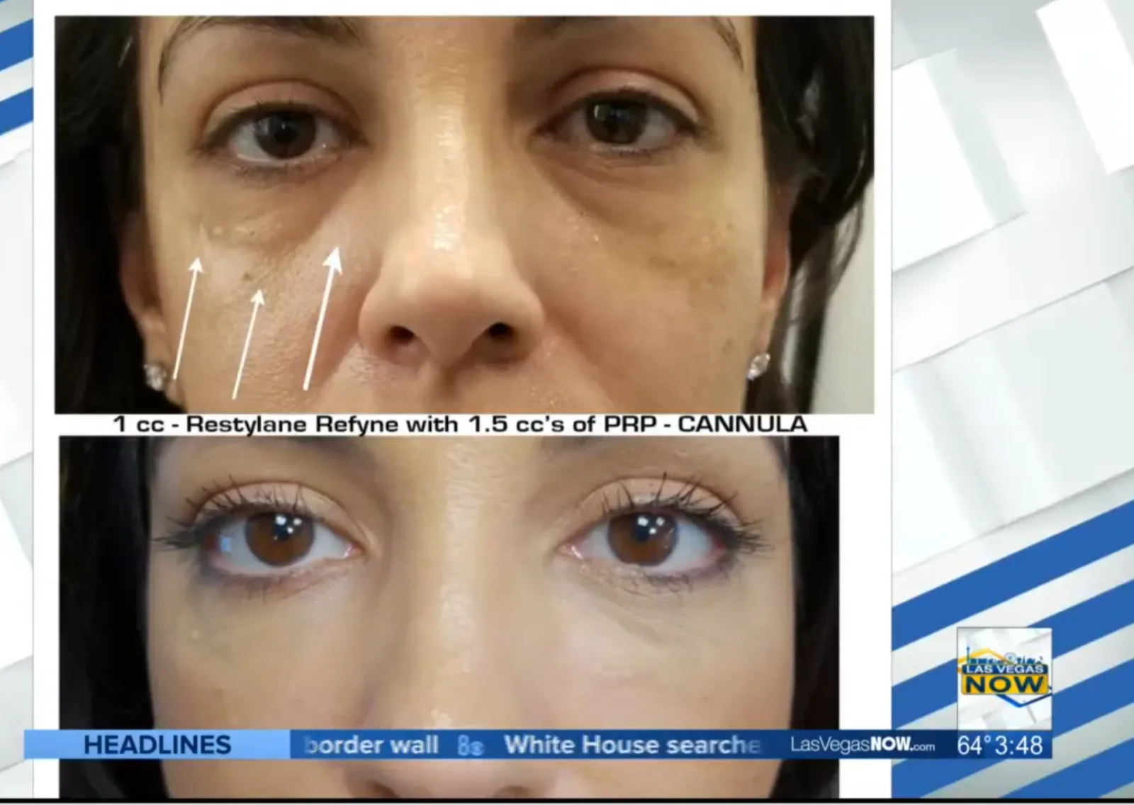 Under-eye filler before and after, Restylane Refyne with PRP, Las Vegas Aesthetics