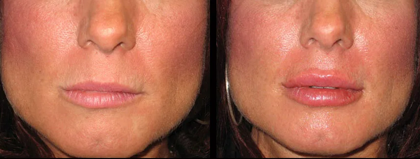 Lip filler before and after, full lip volume, Las Vegas Aesthetics