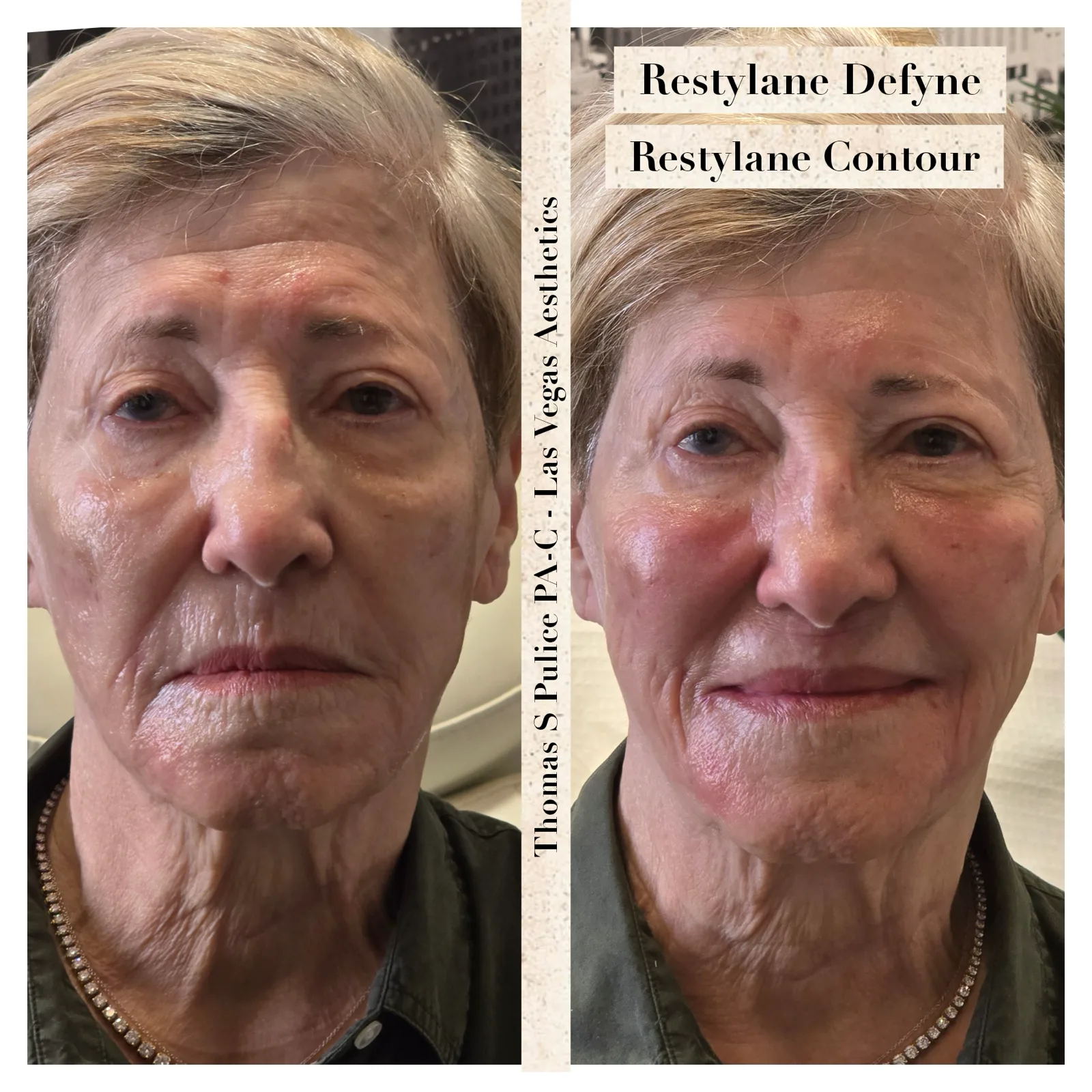 Restylane Defyne and Restylane Contour before and after, Las Vegas Aesthetics