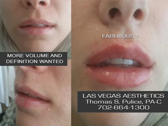 Lip filler before and after, more volume and definition, Las Vegas Aesthetics