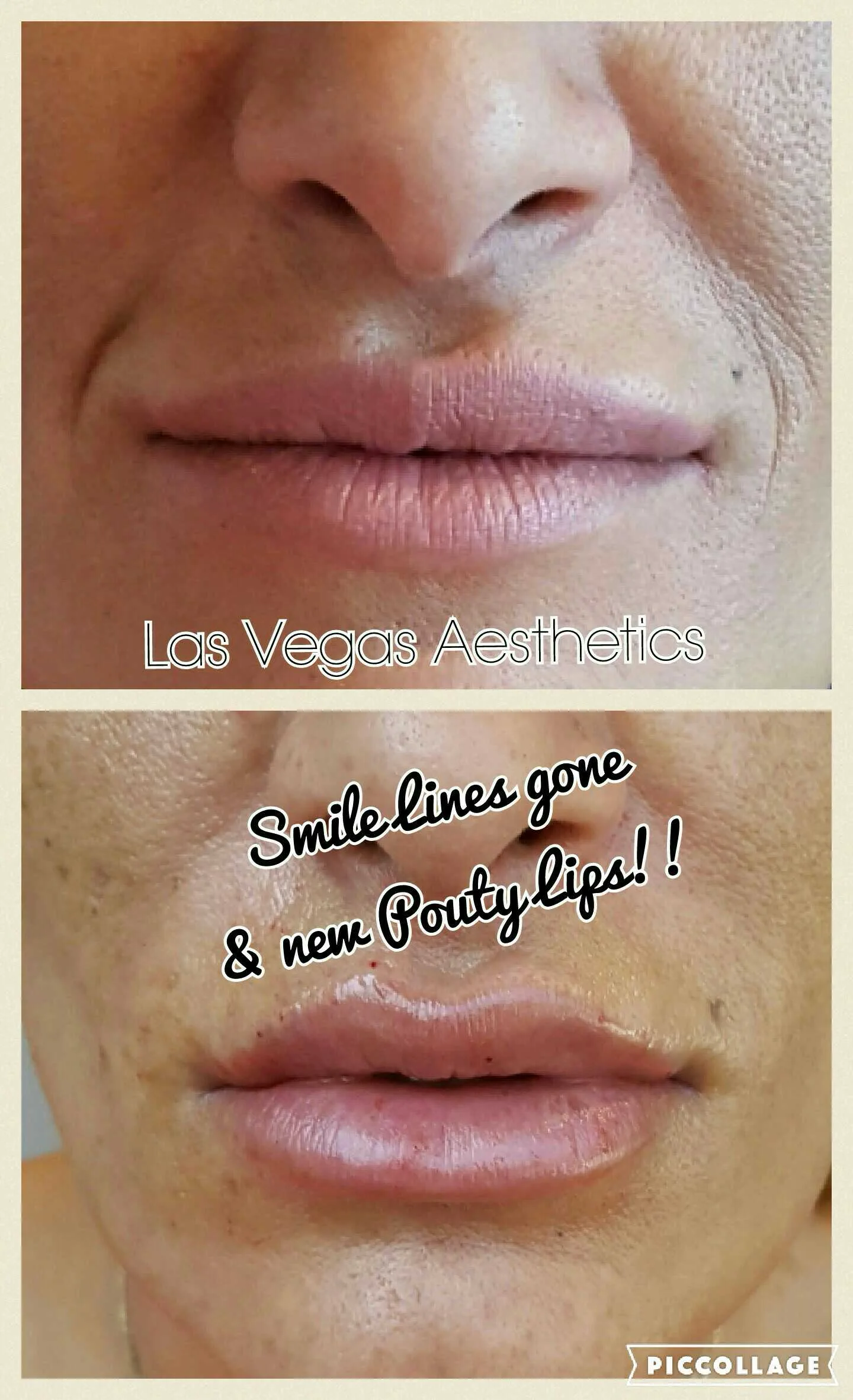 Lip filler before and after, smile lines softened, Las Vegas Aesthetics