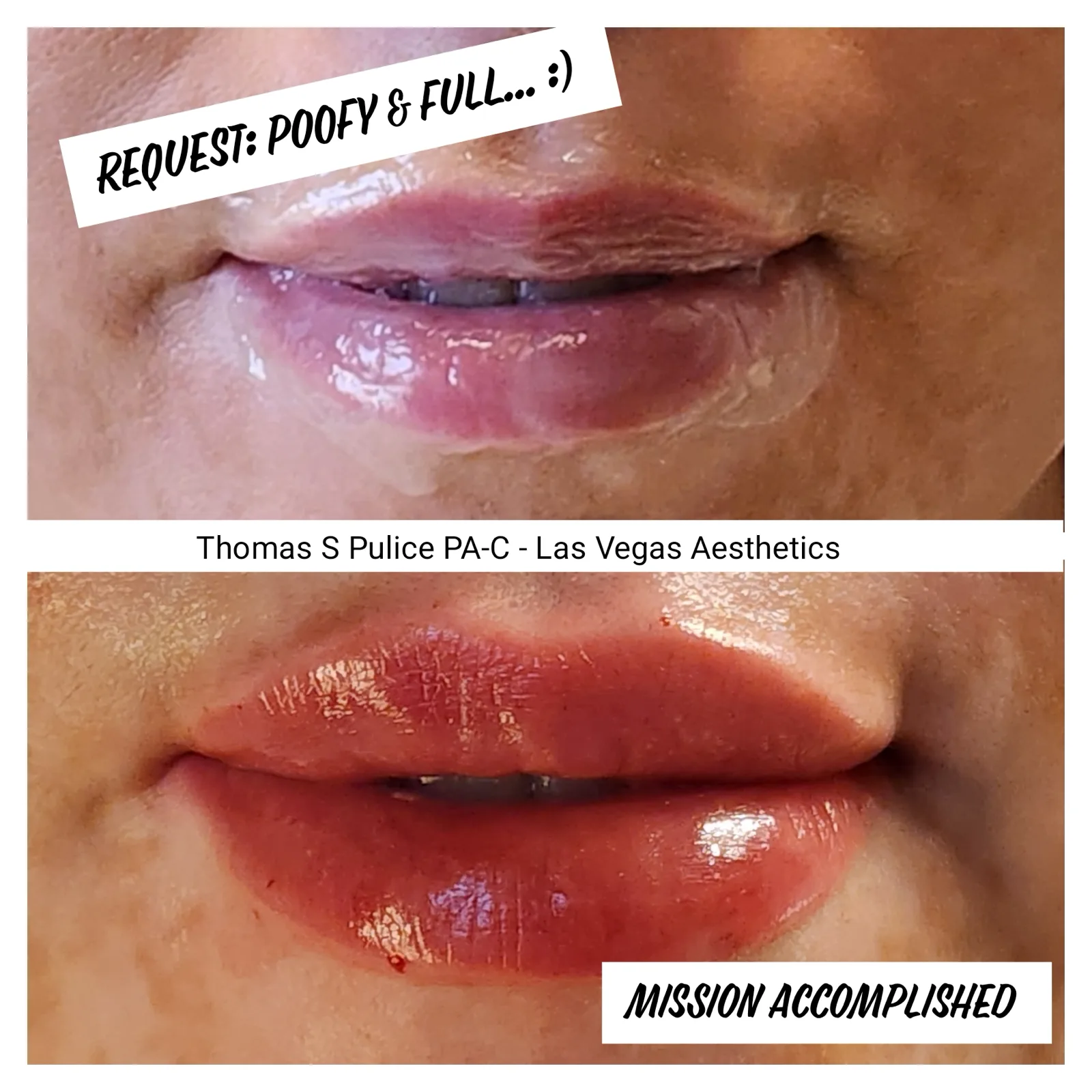 Lip filler before and after, poofy and full lips, Las Vegas Aesthetics