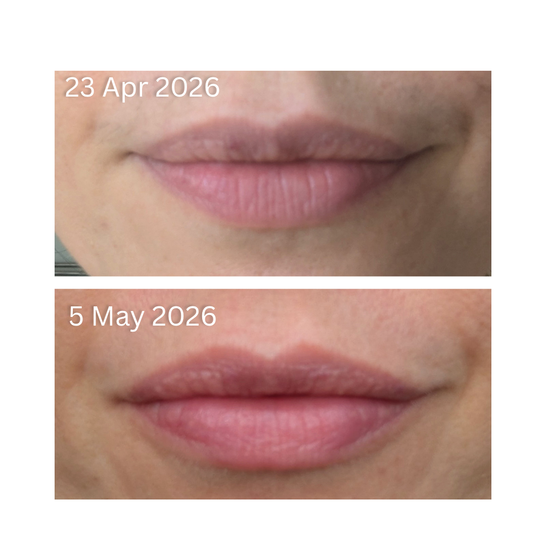 My Lip improvement after 2 weeks