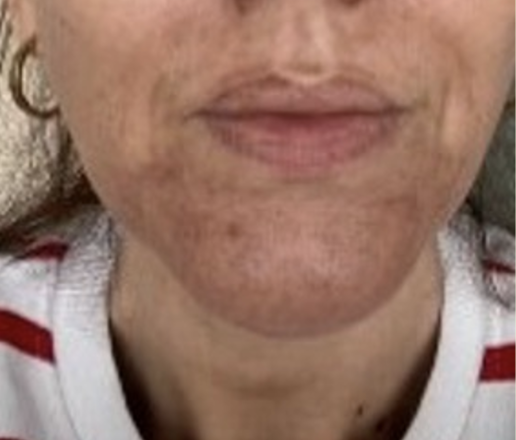 Before treatment