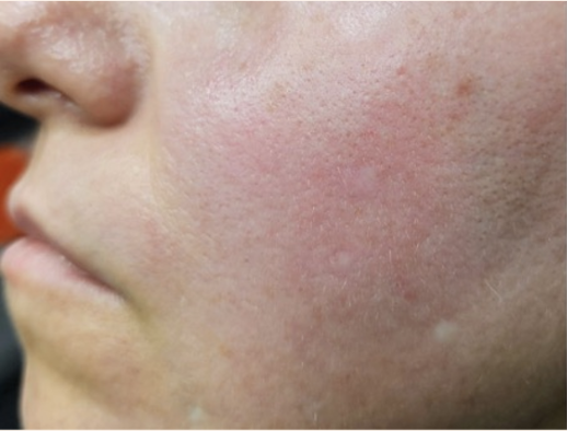 After treatment