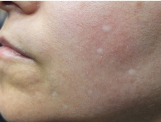 Before treatment
