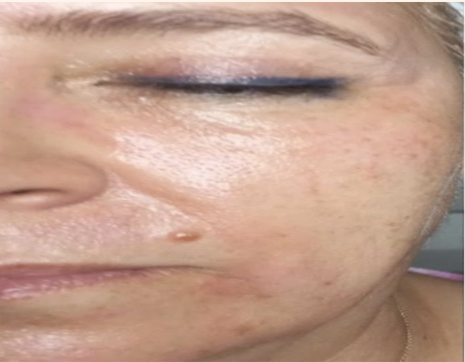 After treatment