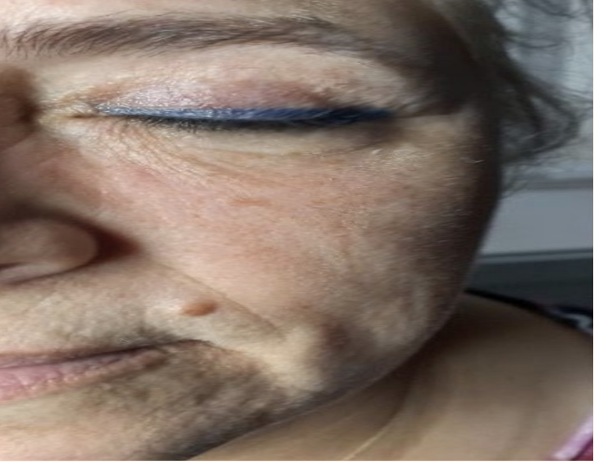 Before treatment
