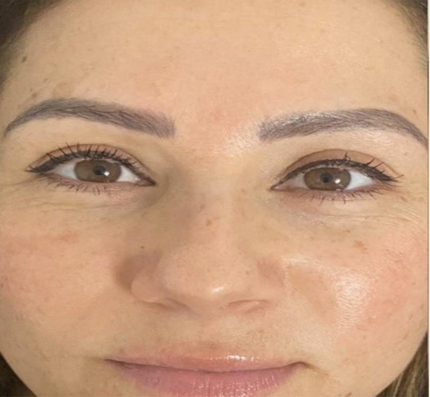 After treatment