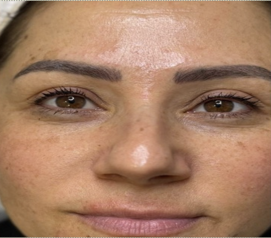 Before treatment