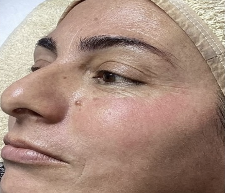 After treatment