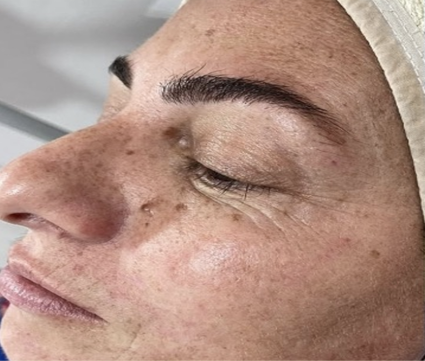 Before treatment
