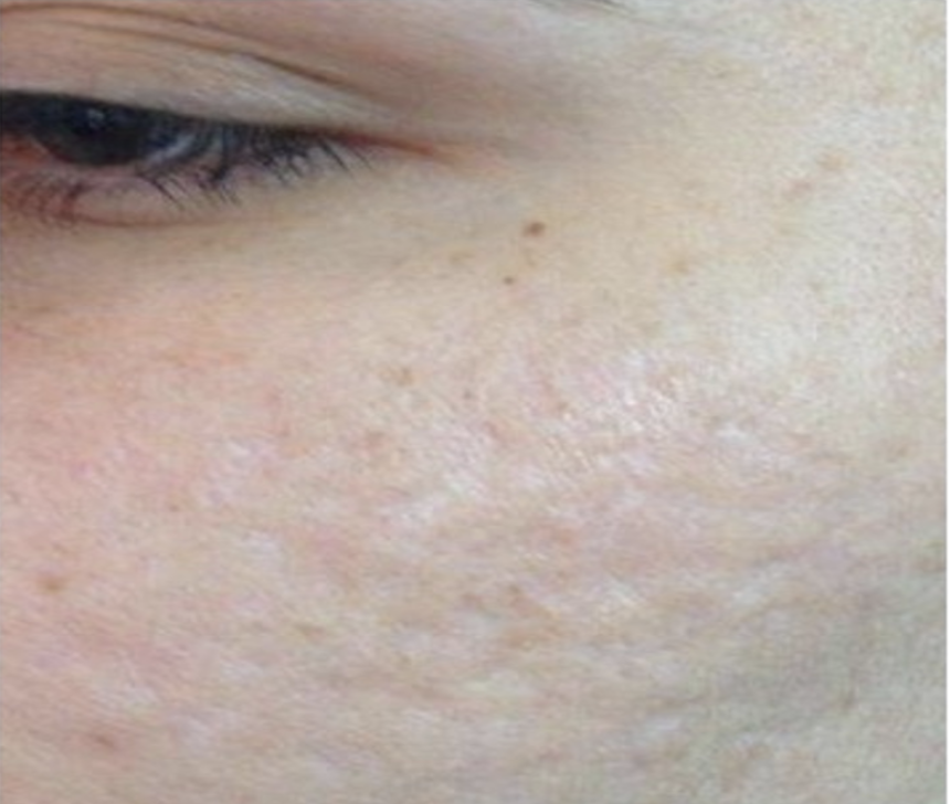 After treatment